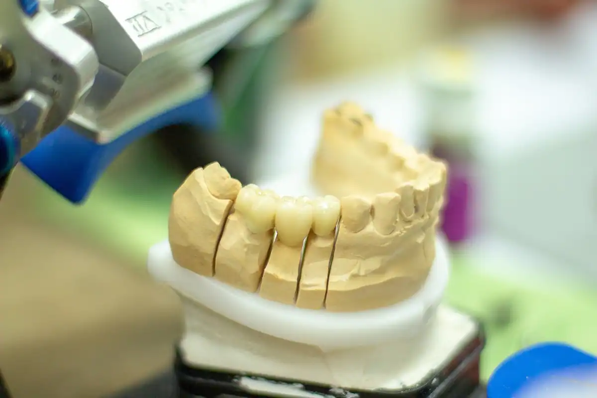 Model dentar din ghips al unei arcade, pregătit pentru lucrarea fixă pe implanturi