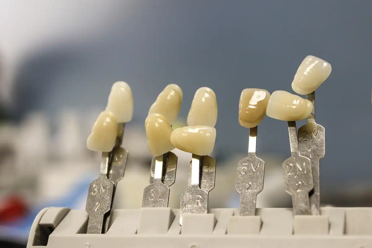 Coroane ceramice dentare montate pe suporturi metalice, văzute de aproape