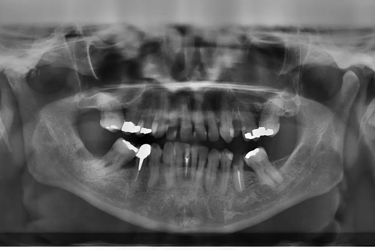Radiografie panoramică a dinților și maxilarelor, în nuanțe de gri