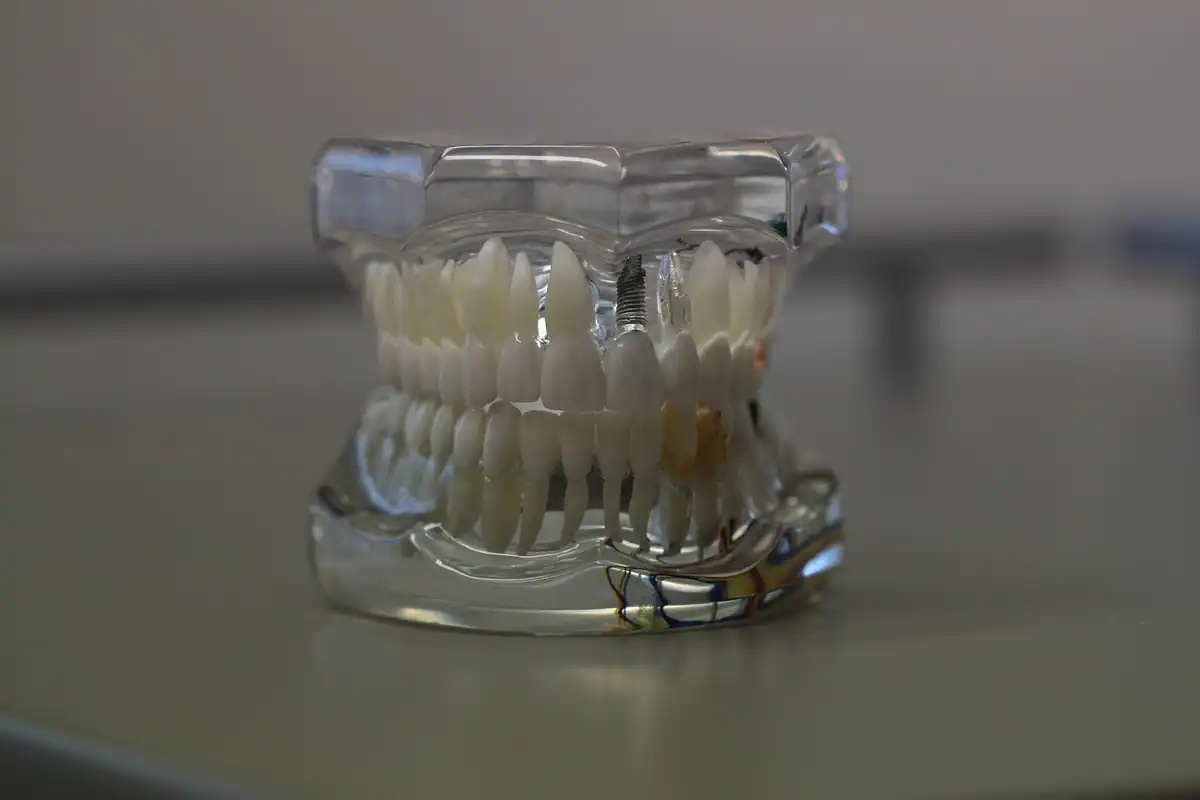 Model transparent al maxilarului cu dinți, folosit pentru explicarea lucrărilor dentare