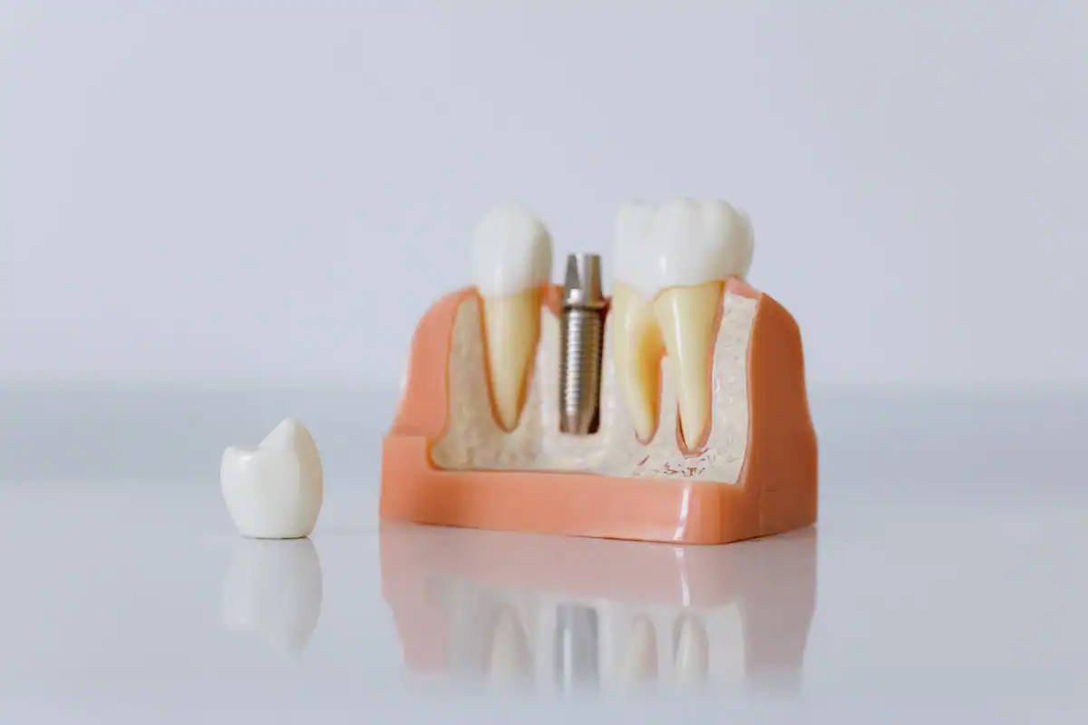 Model dentar cu implant, coroană și dinți vecini, alături de o coroană separată
