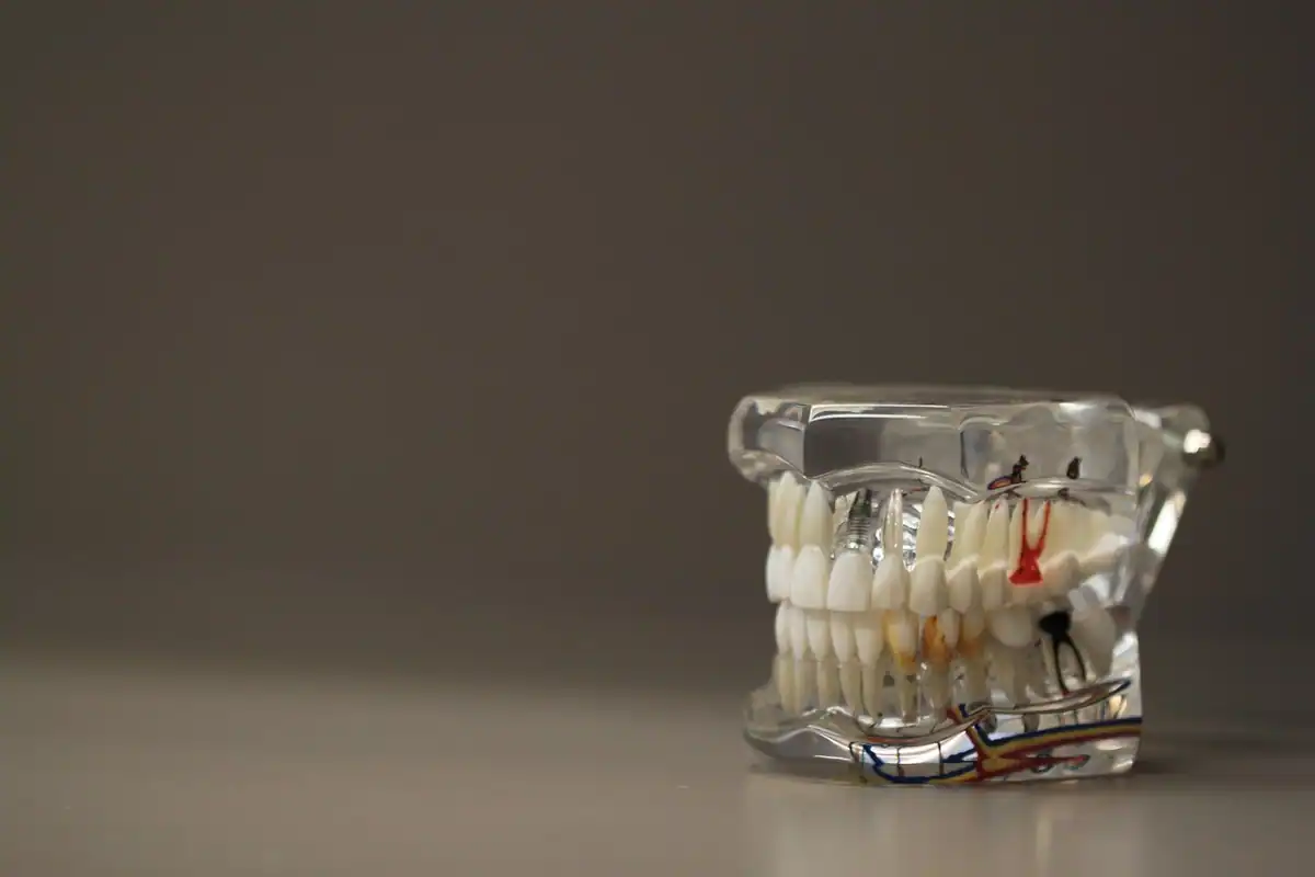 Model dentar transparent al arcadei, cu un implant evidențiat, pe fundal maro