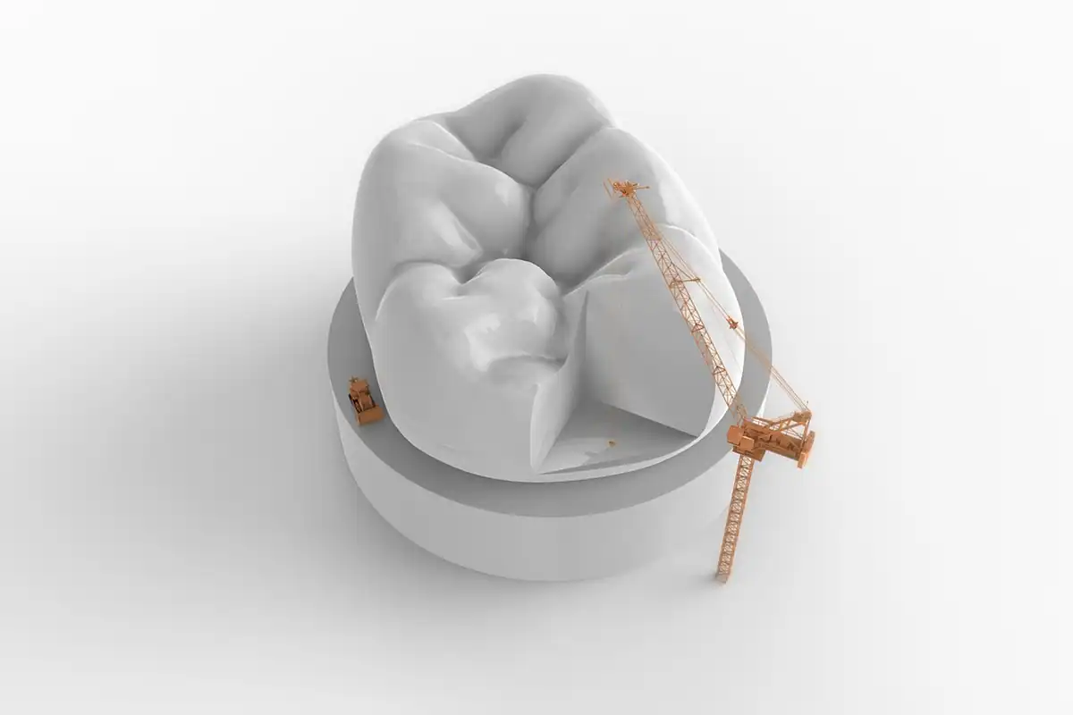Model 3D al unui molar alb, cu o restaurare fixată într-o cavitate