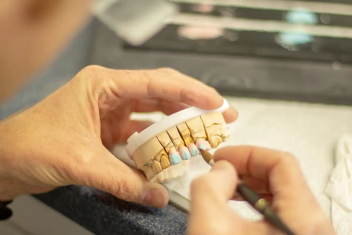 Tehnician dentar modelează cu mâinile o lucrare provizorie pe un model din ghips