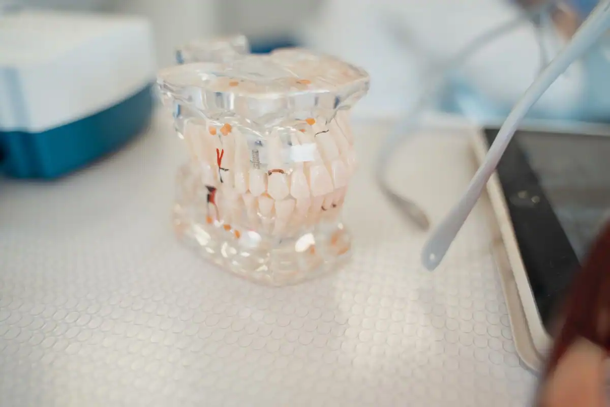 Model dentar transparent cu dinți și implanturi, așezat pe masa cabinetului