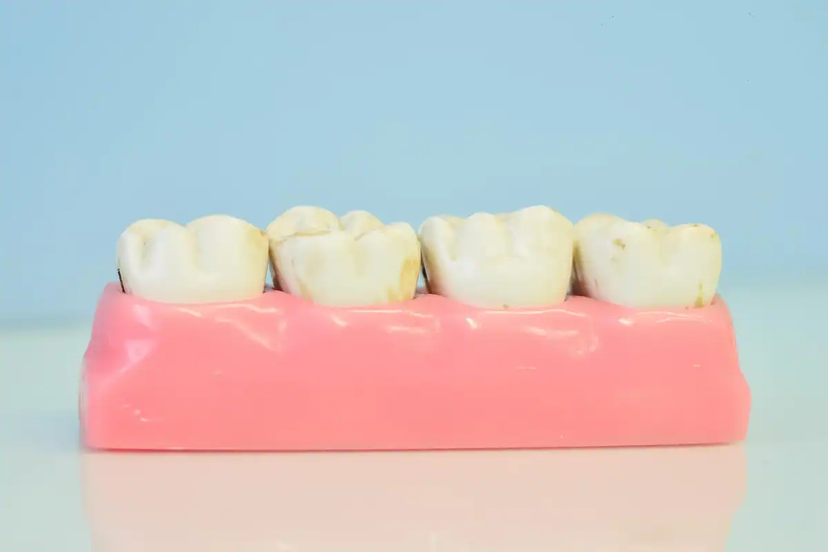 Model dentar cu o punte din patru dinți, așezat pe o bază roz